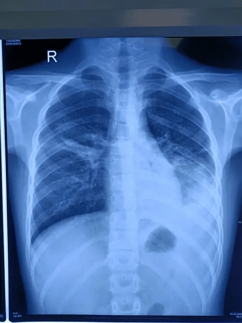 有患者染病后肺部变白。